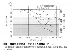 騒音性難聴のオージオグラムの推移